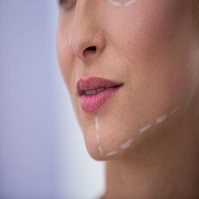 woman-with-marks-drawn-cosmetic-treatment-her-jaw-1000x658